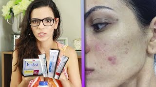 MEU TRATAMENTO DE ACNE COM Tetralysal e Tetraciclina Será que funcionou [upl. by Columba187]