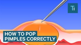 The Only Right Way To Pop Your Pimples [upl. by Leuqer]