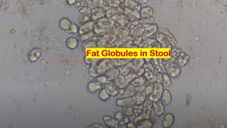 Fat globules in Stool Microscopy [upl. by Breena]