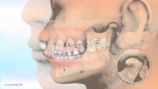 Carriere® Motion™ Appliance for Class II Patients  Braces and Invisalign Ortho  Madison GA [upl. by Tutto532]