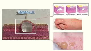 Lesiones elementales dermatológicasAmpolla por Andrea Lizeth Cruz Ramirez 4to quotIquot FMyC UABJO [upl. by Analat]