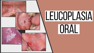 Leucoplasia oral  Odontologia Con Cri [upl. by Osric]