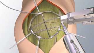 Himawari method for comminuted patellar fractrure [upl. by Coco]