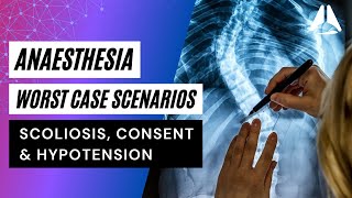 Scoliosis Consent and Hypotension  Anaesthesia Worst Case Scenarios anesthesiology anesthesia [upl. by Teodora]