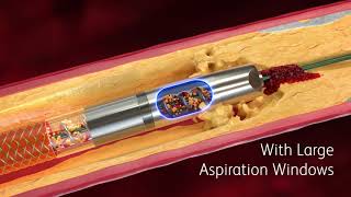 Rotarex™ Atherectomy System Now With Expanded Indications Mechanism of Action Video [upl. by Lavina400]