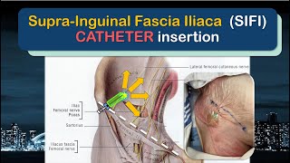 SupraInguinal Fascia Iliaca SIFI Catheter Insertion  the SUPRAINGUINAL approach [upl. by Nagorb648]