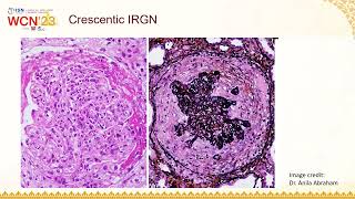 Dr Mythri Shankar  Infection Related Glomerulonephritis at ISN world congress of nephrology 2023 [upl. by Hgielar864]