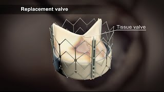 TAVI Transcatheter Aortic Valve Implantation [upl. by Veradi]