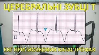 ЦЕРЕБРАЛЬНІ ЗУБЦІ Т ЕКГ при мозкових катастрофах Підвищення ВЧТ та ЕКГ [upl. by Nanek]