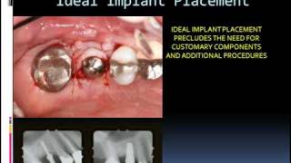 Formula for the Perfect Implant Placement [upl. by Lichtenfeld]