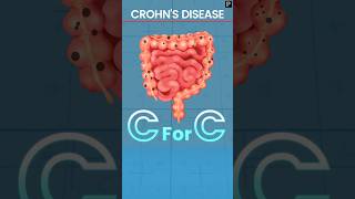 Revise Crohns Disease explained via Mnemonic [upl. by Euqirrne]