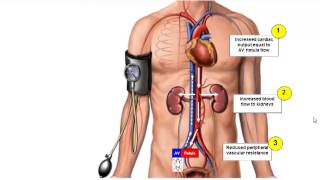 Device Management of Hypertension Beyond Renal Denervation  Mel Lobo [upl. by Duffy]