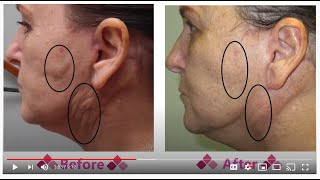 Fibrosis to Face After a Face Lift  Aspen Facelift Treatment for Lumpy Knots [upl. by Groot500]