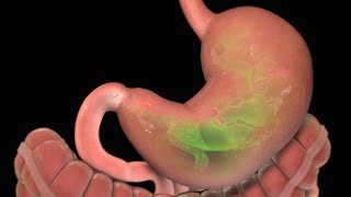 Stomach Ulcer  Nucleus Health [upl. by Ahseenyt]