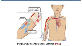 Critical Care Nursing  Parenteral Feeding [upl. by Jeanine]