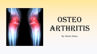 Ortho Osteoarthritis  risk factors causes signs amp symptoms xray findings treatment [upl. by Herries705]