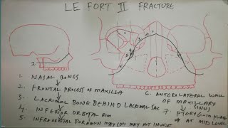 LE FORTII FRACTURE LINE [upl. by Inaluiak]