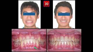 Solving Class III Malocclusion with Anterior Crossbite｜【Chris Chang Ortho】CC723 [upl. by Rosenthal]