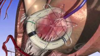 Mitral Heart Valve Ring  Medical amp Scientific Video Production [upl. by Franky685]