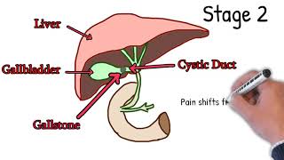 Cholecystitis  Symptoms Causes Treatment How to Detect Cholecystitis Merphy sign Explained Easy [upl. by Dnar595]