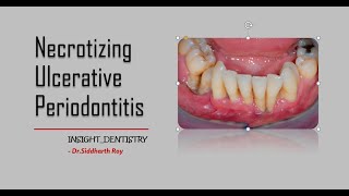 Necrotizing Ulcerative Periodontitis [upl. by Aillil401]