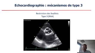 Analyse visuelle des valves du coeur gauche en échocardiographie transthoracique [upl. by Yenial]