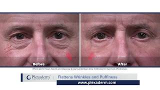 Plexaderm Flattens Wrinkles and Puffiness [upl. by Ecnerret]