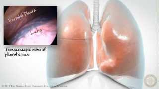 Pleural Space Part 1 of 3 HD [upl. by Krebs]