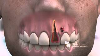 How to treat a dental Fistula [upl. by Ark]