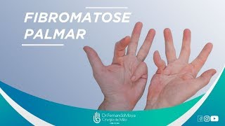 Fibromatose palmar o que é  Dr Fernando Moya CRM 112046 [upl. by Rehptsirhc139]