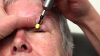 Blepharitis Treatment That Really Works Blephex Eyelid Cleaning [upl. by Tertius]