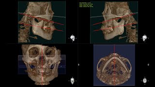 Prosthesis production using BTS and AI occlusal plane [upl. by Jeramey552]