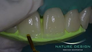 Fechamento de Diastema e Aumentos Incisais [upl. by Alleirbag]