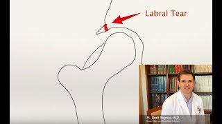 Hip Impingement FAI and Labral Tears Explained  Dr Brett Raynor [upl. by Silvers]