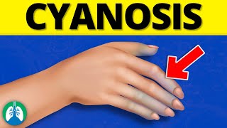 What is Cyanosis EXPLAINED [upl. by Chiquita92]