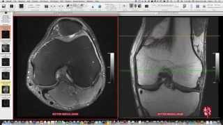 Systematic Interpretation of Knee MRI How I do it [upl. by Eiddet]