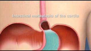 Barretts Esophagus Intestinal Metaplasia of the CardiaMayo Clinic [upl. by Erodavlas660]