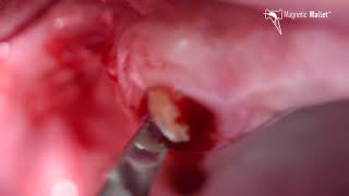 Ankylosed tooth extraction using the MAGNETIC MALLET [upl. by Effy462]