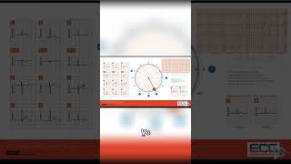 Mastering EKG Interpretation Decoding a Normal RWave Progression [upl. by Garbers]