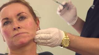 Full face filler treatment  nonsurgical volumetric facelift [upl. by Treboh401]