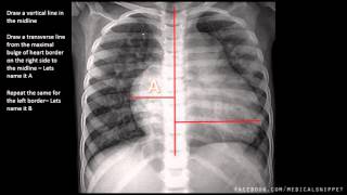 How to measure Cardiomegaly in CXR [upl. by Erdnad]