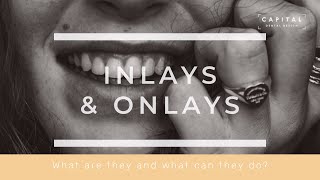 Dental Inlays amp Onlays Explained by Richmond Cosmetic Dentist Dr Graham Forbes [upl. by Niple]