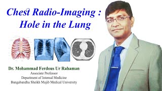 Chest XRay Hole in the Lung [upl. by Teressa]