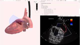 HeartWorks Unilobed Left Atrial Appendage [upl. by Sonja267]