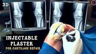 Injectable Plasters For Cartilage Repair  Animated Video [upl. by Doreen]