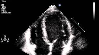 Ecocardiograma Doppler [upl. by Henri]