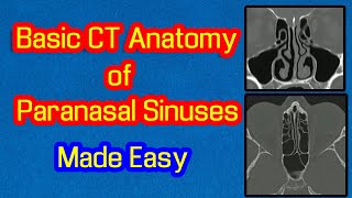 Basic CT Anatomy of Paranasal Sinuses Made Easy [upl. by Lawlor419]