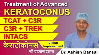 Advanced Keratoconus Treatment C3R Plus TCAT with C3R TREK INTACS  Keratoconus Surgery [upl. by Ydahs]