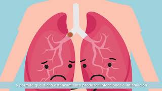 Vídeo 1  ¿Qué es la Fibrosis Quística [upl. by Lehcyar]