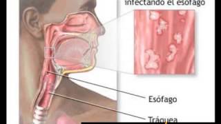 Treatment Of Candida Glabrata [upl. by Lapides]